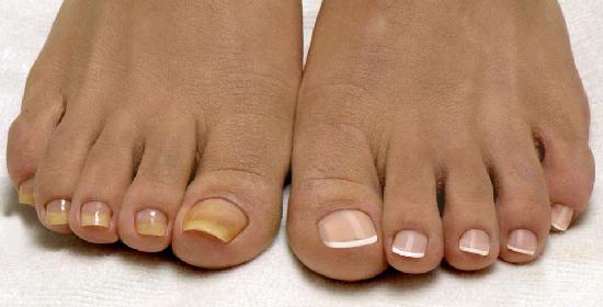 foot nail gombák