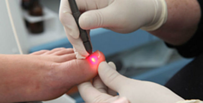 nail gombusz kezelési megoldás hatékony lakk köröm gomba elleni lábakon