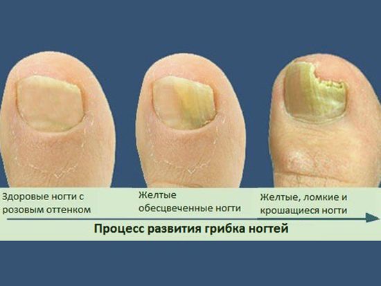 nail gombusz a lábakon modern kezelés)