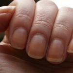 What do mycelium threads on nails mean?
