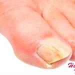 ¿Qué significan los hilos de micelio en las uñas?